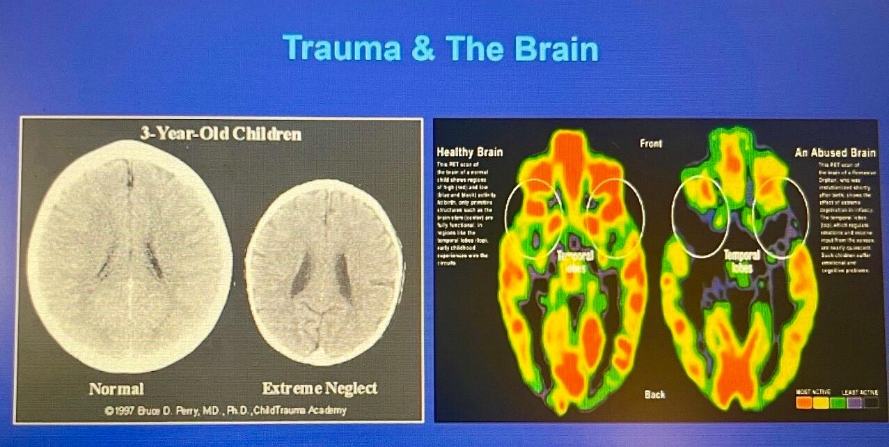 Tác động của Lạm dụng & Bỏ bê đến sự phát triển não của trẻ nhỏ